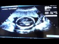 Rachel's 20 week Pregnancy Ultrasound - It's a .....