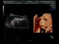 ultrasound 3d 4d
