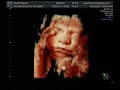 ultrasound 3d 4d