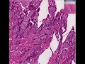 Histopathology Uterus--Choriocarcinoma