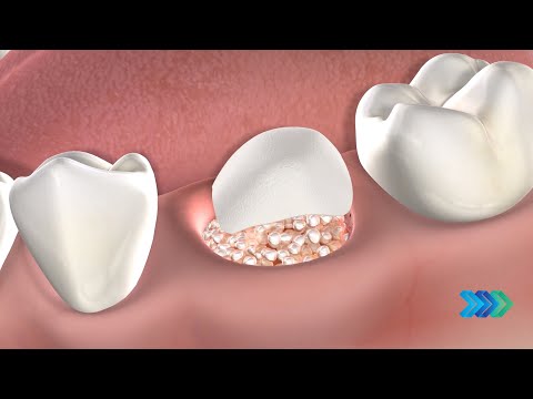 Bone Grafting at Huntsville Oral Surgery & Dental Implants in Huntsville, AL