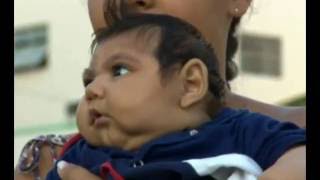 Concern Zika causes baby eye problems Concern Zika causes baby eye problems