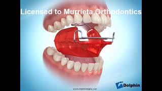 Murrieta Orthodontics Bionator