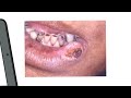 Worried That You Might Have Oral Cancer? Call 650-965-1234 today!