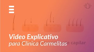 ExplicaPlay - Transplante Capilar - Video Explicativo