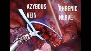 Robotic assisted Right Upper Sleeve Lobectomy
