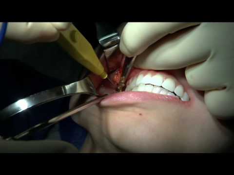 communication with buccal fat pad flap or PowerPoint Presentation on The communication with buccal fat pad flap or PowerPoint Presentation on The