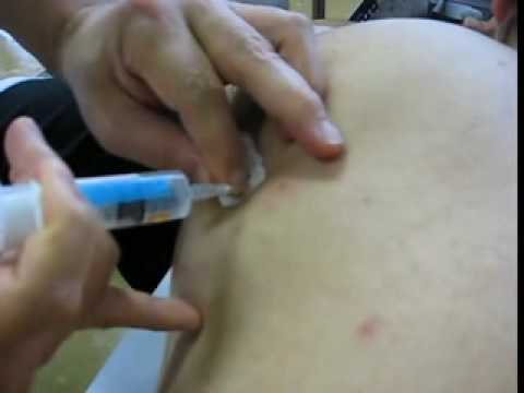 Myofascial Pain Disorder