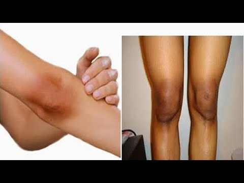 Trị Thâm, Làm Trắng Da Vùng Đầu Gối Khuỷu Tay, Mắt Cá Chân Tự Tin Diện Váy Xinh Mẹo Xóa Vết Thâm