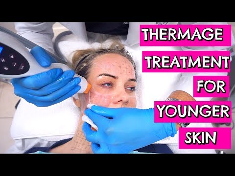 THERMAGE LASER EXPERIENCE, before and after pics
