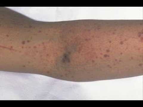 extremely high platelet counts