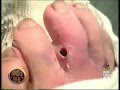 Gusano en el dedo del pie