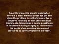 image Erectile Dysfunction Pump Implant
