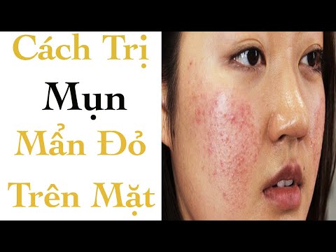 Cách Trị Mụn Mẩn Đỏ Ngứa Trên Mặt - Mỹ Phẩm SOSENCO