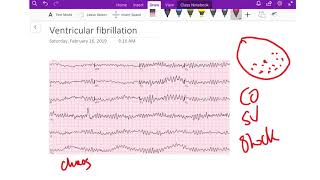 ventricular fibrillation - Dr Jamal USMLE - cardiology ECG lecture