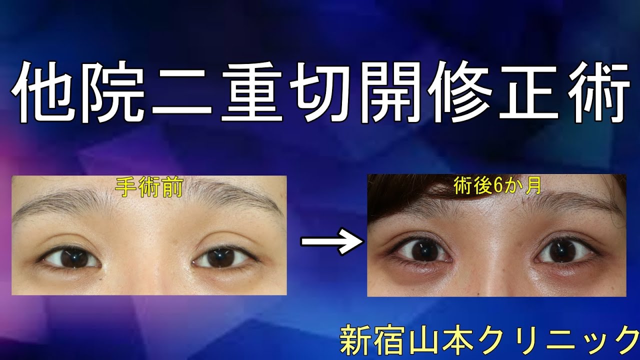 二重修正+挙筋瞼膜処置 山本クリニック