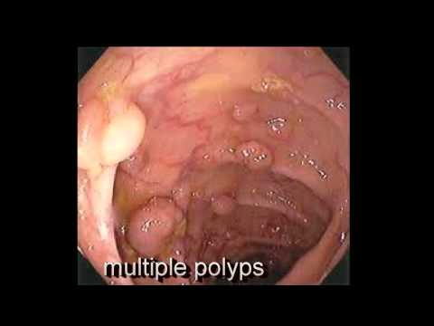polyp rectal colonoscopy colon tems surgery wn follow