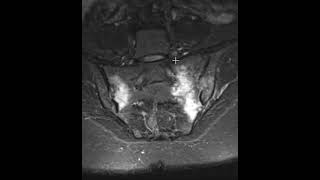 Sacral Stress Or Insufficiency Fractures