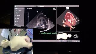 Echo case - "can't sleep, can't walk", dyspnea and orthopnea - Basic Echocardiogram
