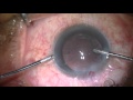 Cataract surgery by Dr. Vikas Kanaujia