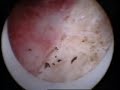 endometrium