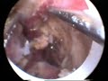 endometrium