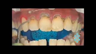 Limpieza Dental De Sarro