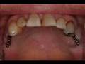 IMTEC Mini Dental Implants and Full Bridges