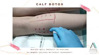 What is Calf Botox? | Astute Medical Aesthetics & Laser Clinic