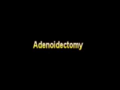 Header of adenoidectomy