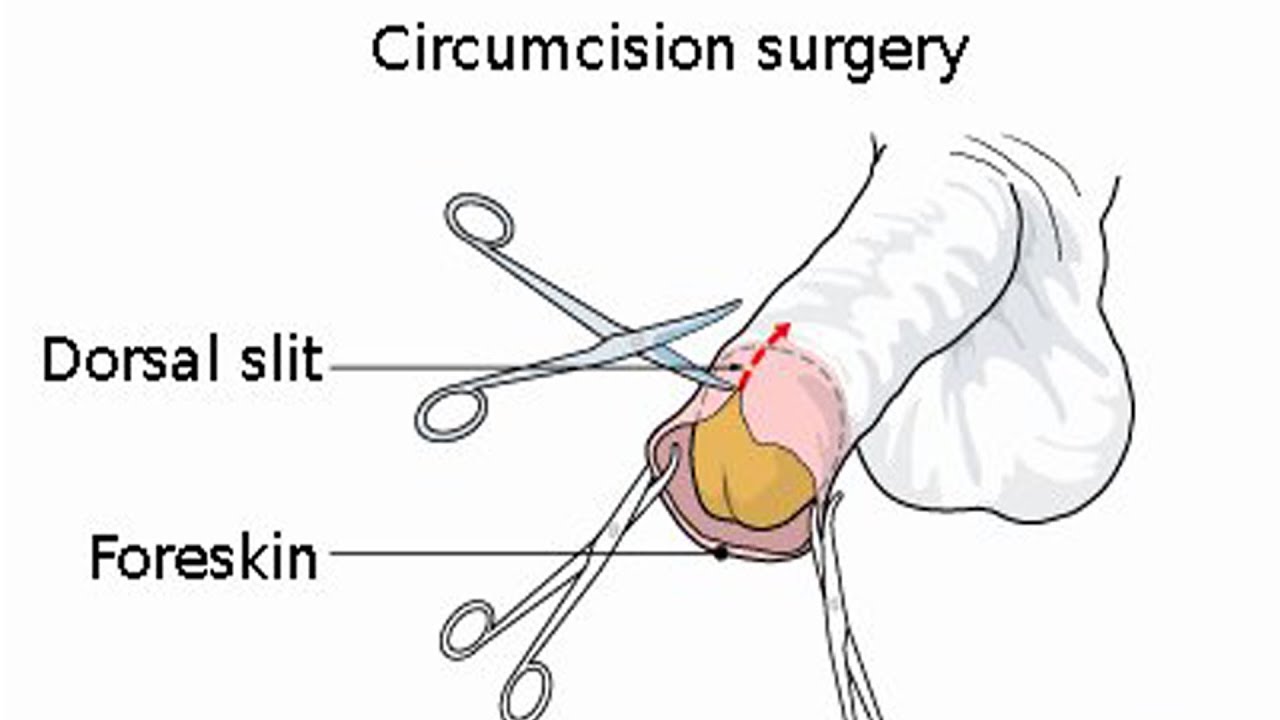 Circumcised uncircumcised