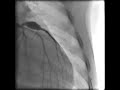 Cardiac Catheterization of 9mm Left Coronary Artery Aneurysm