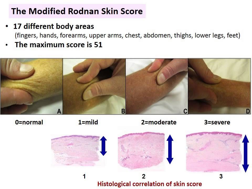 Scleroderma plaque fibrosis facial lesions