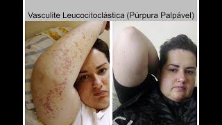 Vasculite Leucocitoclástica (Púrpura Palpável)