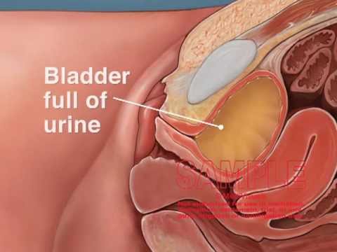 Catheterization Technique for the Urinary Bladder of a Female - YouTube