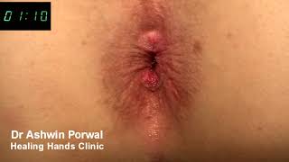 Laser Sphincterolysis for severe Anal Spasm | Cure for Anal Fissure | Dr Ashwin 