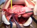 Hysterectomy for Benign Disease #4