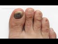 How to Prevent & Treat Black Toenail | Foot Care