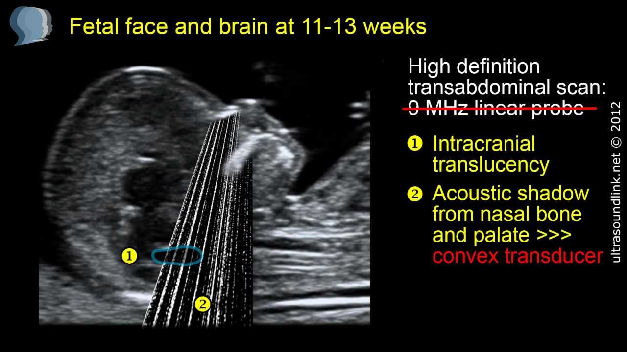Fetal face and brain: high definition scan at 11-13 weeks - YouTube