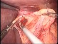 Laparoscopic Type III hiatal hernia repair