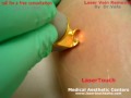 Laser Vein Removal .wmv