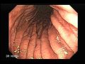Endoscopy