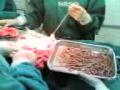 Cirurgia para retirada de vermes do intestino