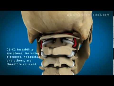 C1 and C2 Atlantoaxial Instability - YouTube