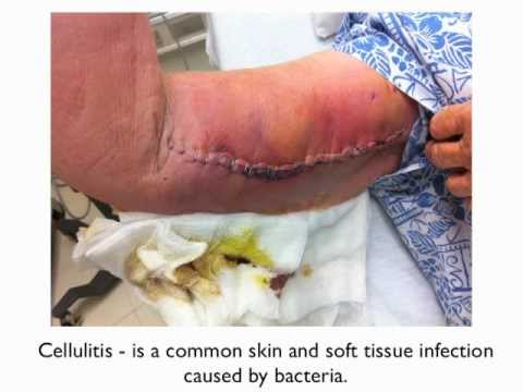 teaching plan for patient with cellulitis Nursing care plan a client with a rapidly progressive cellulitis that begins between the base of ms ironhorse plans and implements the following interventions. teaching plan for patient with cellulitis Nursing care plan a client with a rapidly progressive cellulitis that begins between the base of ms ironhorse plans and implements the following interventions.