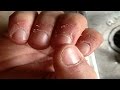 Home remedies for hangnails