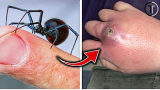 Black Widow Spider Bite  Black Widow Spider Bite Symptoms