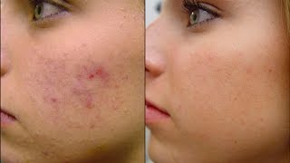 Acne Treatment Routine Flawless Skin  ( Full Coverage Tutorial ) Cystic & Scaring ARGAN Life