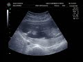 Baby C first sonogram