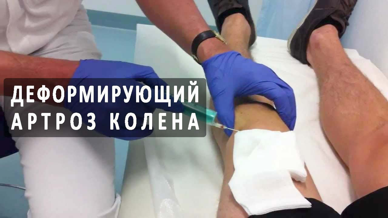 Код мкб-10 доа тазобедренного сустава Код мкб-10 доа тазобедренного сустава